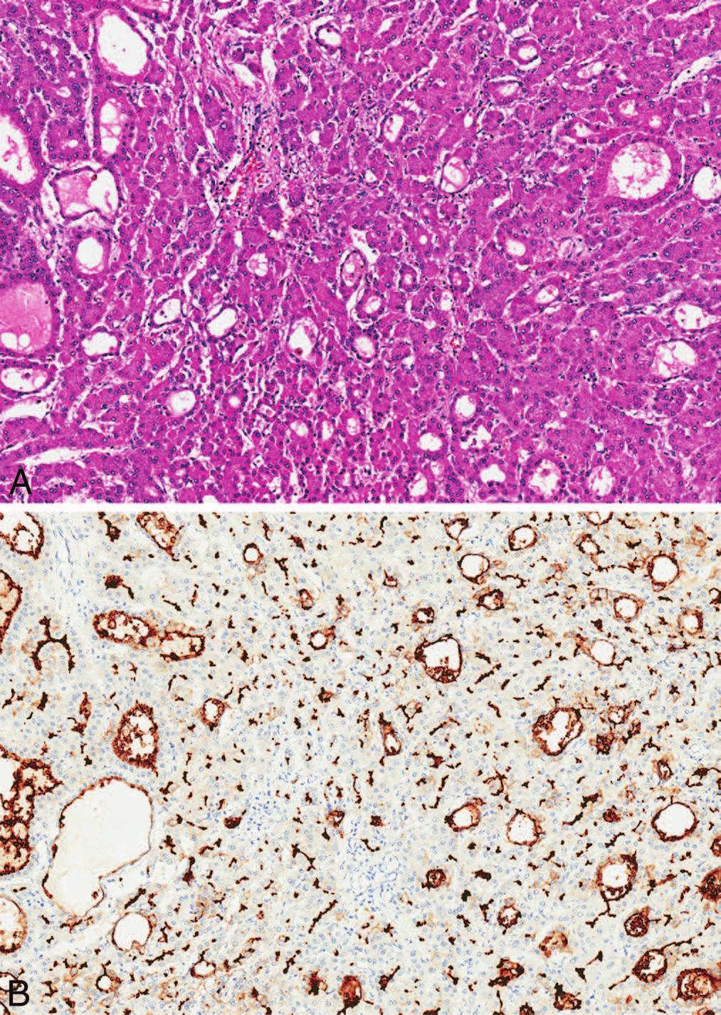 Figure 1. A, Well-differentiated hepatocellular carcinoma.