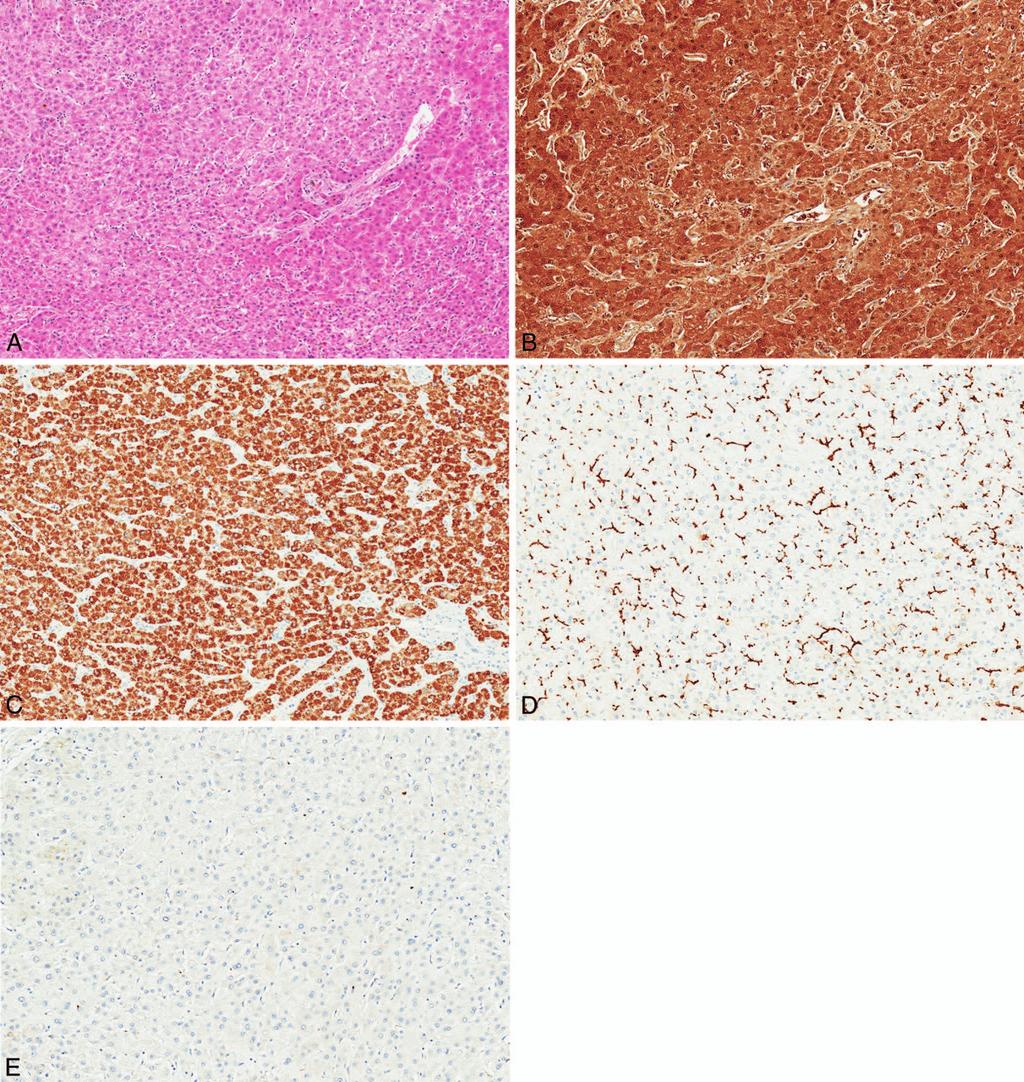 Table 3. Immunohistochemical Markers in Hepatocellular Carcinoma With 50%a Staining Considered Positive Differentiation Arginase-1, No. (%) Glypican-3, No. (%) Hep Par-1, No. (%) pcea, No.