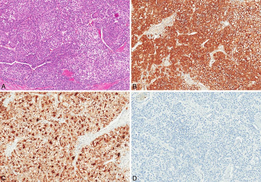 Figure 3. Moderately differentiated hepatocellular carcinoma (A) showing cytoplasmic staining with arginase-1 (B) and glypican-3 (C), whereas hepatocyte paraffin antigen 1 (Hep Par 1) is negative (D).