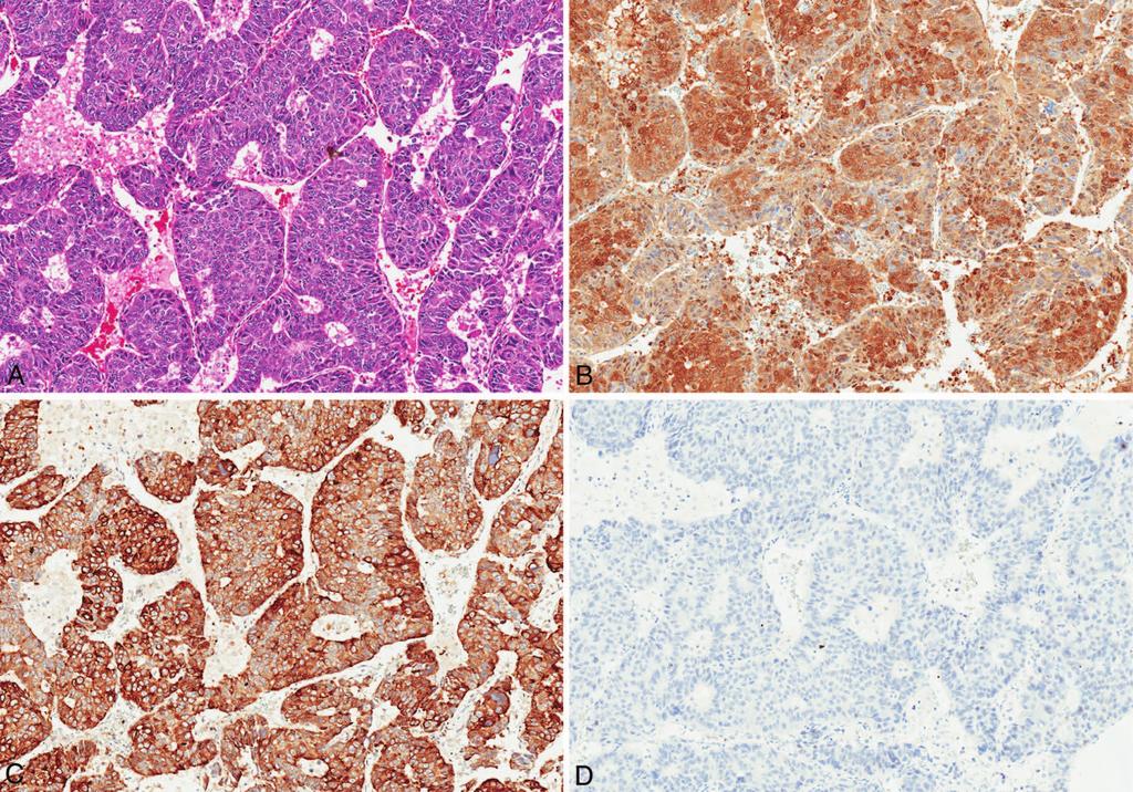 Figure 4. Poorly differentiated hepatocellular carcinoma (A) showing cytoplasmic staining with arginase-1 (B) and glypican-3 (C), whereas bile salt export pump was negative (D).
