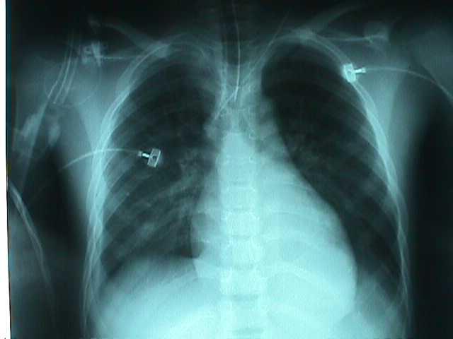 non-cardiogenic pulmonary edema