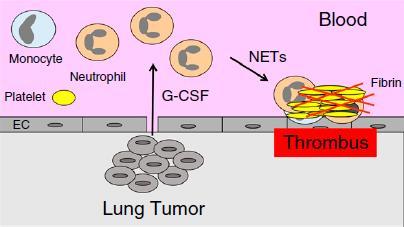 Cancer Type-specific Biomarkers NETs = neutrophil extracellular traps