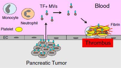 Cancer Type-specific Biomarkers Tumor-derived TF+ MVs trigger