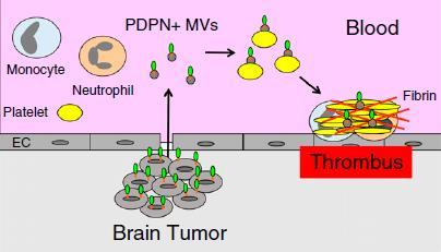 Cancer Type-specific Biomarkers PDPN = podoplanin Tumor-derived PDPN+