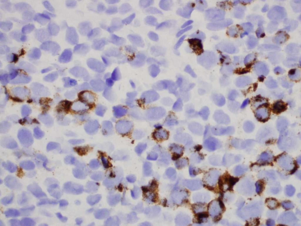 WHO 2004 Small Cell Carcinoma