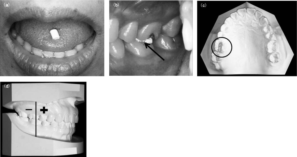 90 KUROKAWA, KANZAKI, TOKIWA, HANDA, NAKAOKA, HAMADA, KATO, NAKAMURA Figure 2. Identifiction of the min occluding re using piece of dentl stopping. () Plcement of the stopping on the tongue.