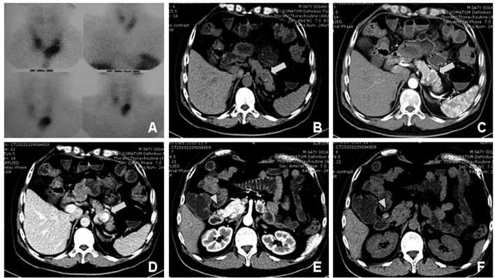 Figure 5. Imaging data of patient 2. 99m Tc-MIBI scan (A) showed enlargement of left parathyroid gland.