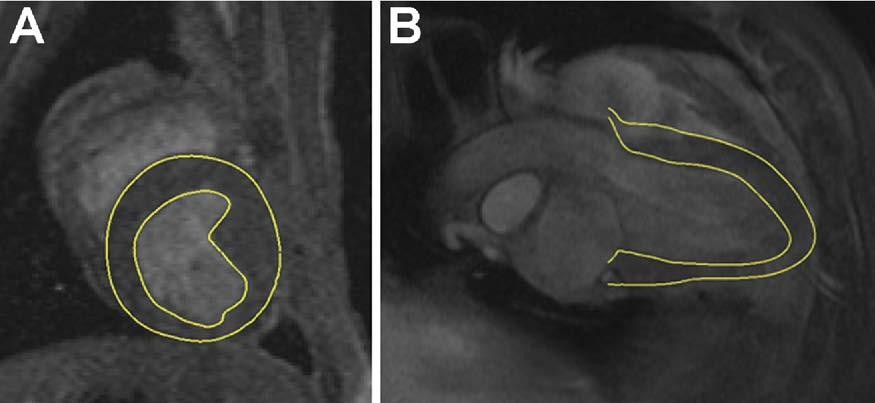 Ann Thorac Surg WENK ET AL 2010;89:1546 54 FE MODEL OF LV WITH MITRAL VALVE 1547 Fig 1. (A) Short-axis and (B) long-axis magnetic resonance imaging slices with contour lines.