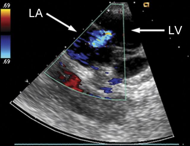 1550 WENK ET AL Ann Thorac Surg FE MODEL OF LV WITH MITRAL VALVE 2010;89:1546 54 Table 2.