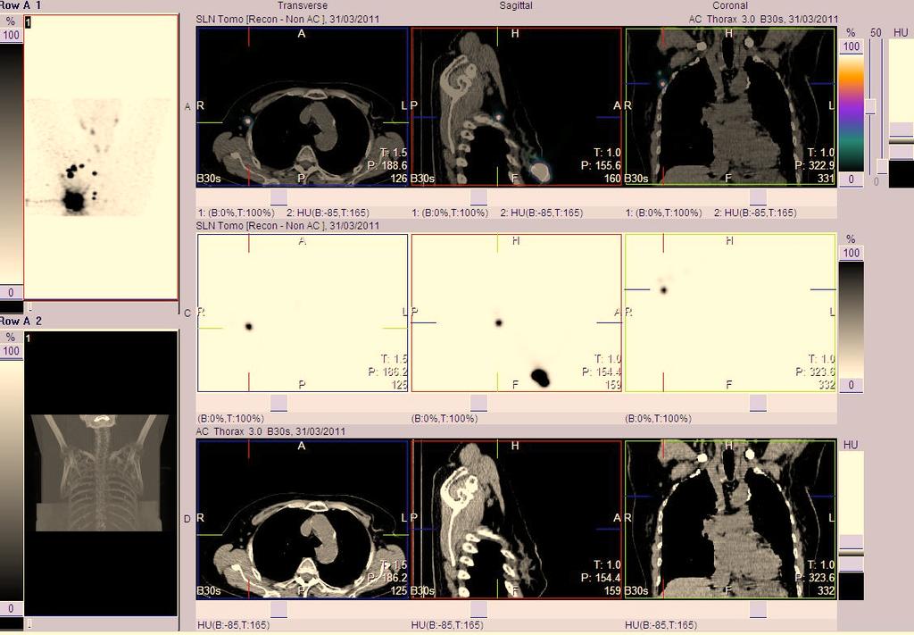 Sentinel Lymph Node Identification in Breast Cancer The Open Nuclear Medicine Journal, 2012, Volume 4 9 Fig. (2).