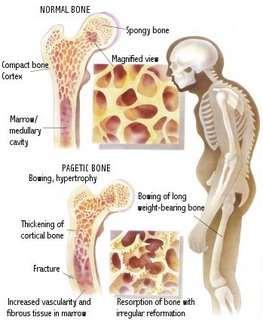 Paget s Disease What is Paget s? Bones grow too large and weak Can be in any bones, but most often in spine, pelvis, skull or leg bones.