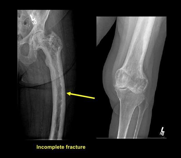 Clinical Presentation and Complications Fracture Arthropathy Impacts Joints Skin temperature Hypervascularity due to bone turnover ac vity bone turnover causes cardiac demands and may lead to