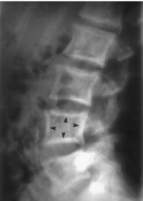 Diagnostic Testing Plain Radiographs Localized Demineralization (Early) Bone Overgrowth (Later) Classic picture frame appearance in pagetic vertebra (marginal sclerosis) Diagnostic Testing Bone Scan
