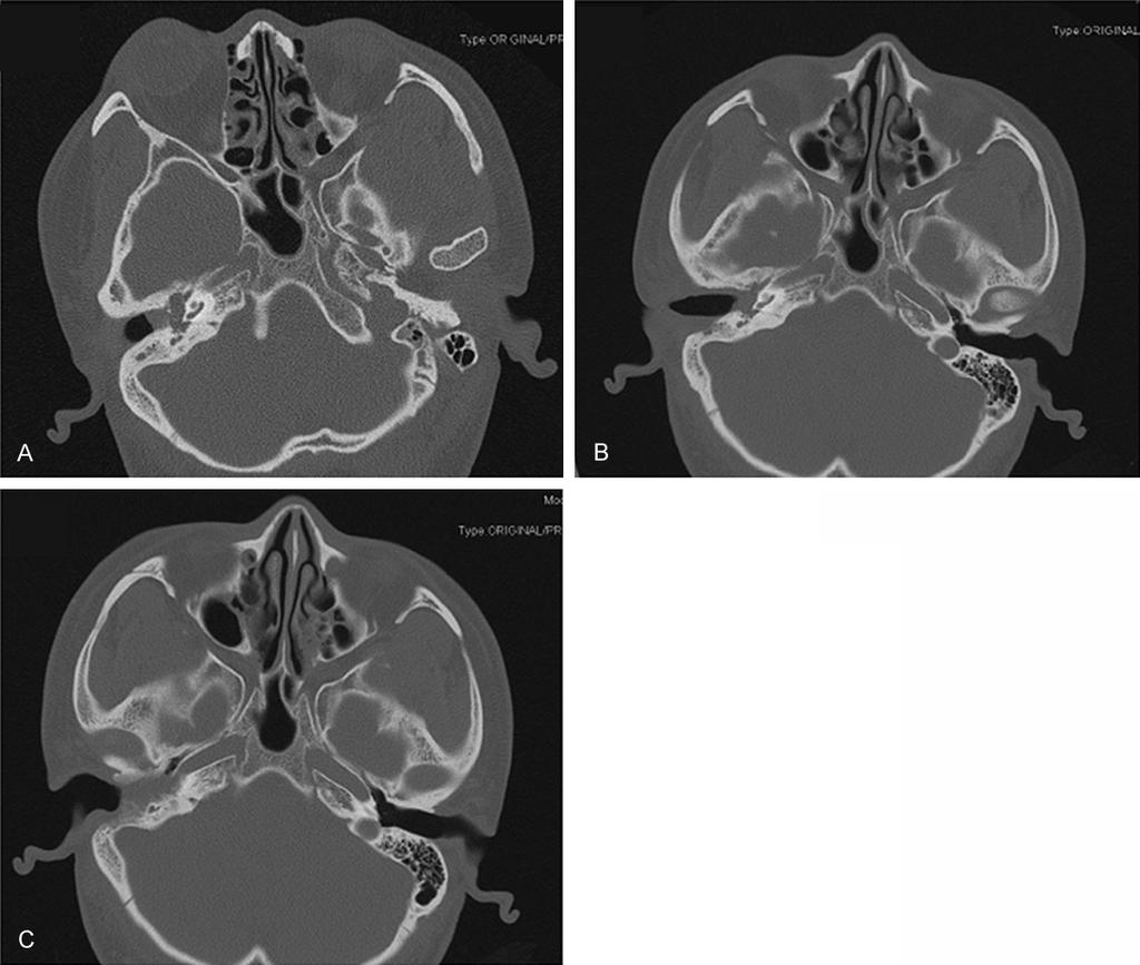 Figure 1. A. CT showed that the tympanum and mastoid were filled with an isodensity mass without osteolytic invasion at the first time. B.