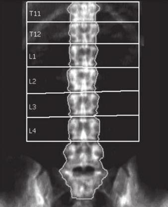 centered spine., DEX image of left proximal femur shows four ROIs are femoral neck, trochanter, intertrochanteric region, and Ward triangle.