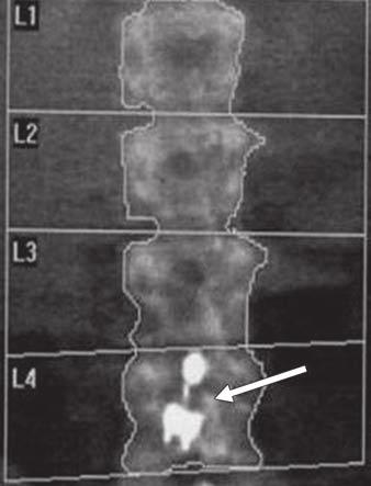 3, indicating presence of osteopenia. Fig. 5 rtifacts caused by dense objects., 18-year-old girl with anorexia nervosa.