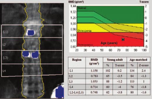 Lorente-Ramos et al. Fig. 6 rtifacts caused by contrast material. Green = normal, yellow = osteopenia; red = osteoporosis, MD = bone mineral density.