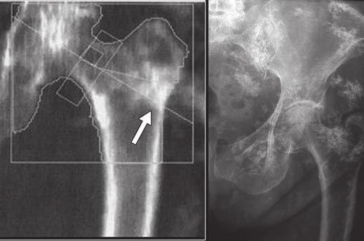 Erroneous increase in bone mineral density (arrow) precludes analysis. Fig. 9 67-year-old woman with bone graft.