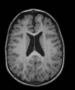 lateral ventricles was observed in one patient after 13 weeks of treatment, which stabilized at 26 weeks of treatment In a 15 year old, with