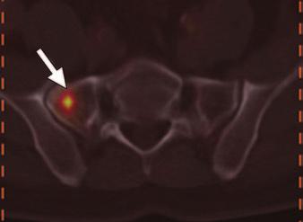 B and C, PET/CT (B) and CT (C) images show multinodular pancreas with areas of increased tracer uptake consistent with primary lesions.