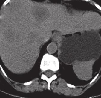 PET/CT of Gastroenteropancreatic NETs A Fig. 3 49-year-old woman with carcinoma of unknown primary of neuroendocrine origin.