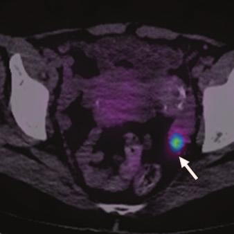 octreotide-based treatment. In the current study, a significant overall impact of 68 Ga-DOTA-NOC PET/CT was seen on the management of patients with gastroenteropancreatic NETs.