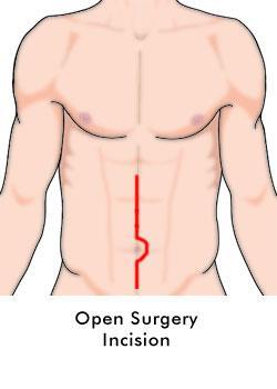 PART II: AFTER SURGERY Post-Discharge Major/Laparoscopic (Abdominal) Surgery Instructions This information helps you understand how your post-discharge recovery should progress, so you have realistic