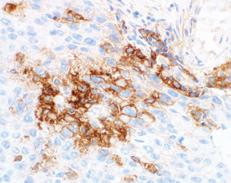 See page 20 for an example of a pathology report form for PD-L1 IHC 28-8 pharmdx.
