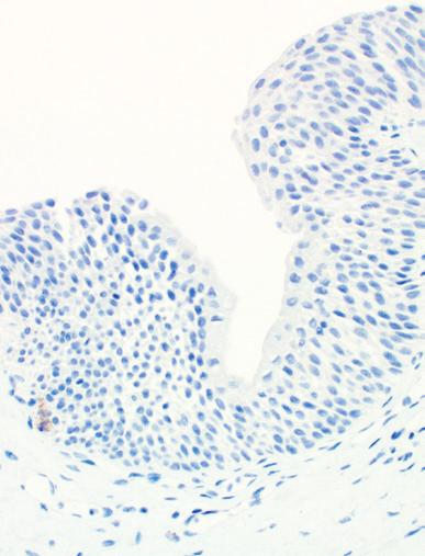Figure 15B: Urothelial carcinoma of the bladder showing in situ component (red arrow) staining for PD-L1 in  When