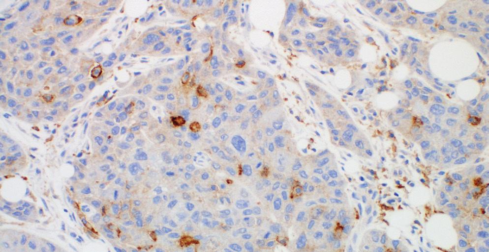 Challenging Cases for UC PD-L1 IHC 28-8 pharmdx Non-Specific Background Staining Background staining is defined as diffuse, non-specific staining of a specimen. It is caused by several factors.
