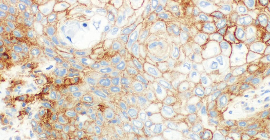 stain. 20x magnification. Figure 22: PD-L1 positive staining observed in urothelial carcinoma of the bladder.