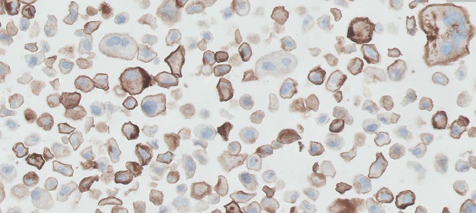 Recommendations for Interpretation of PD-L1 IHC 28-8 pharmdx in UC PD-L1 IHC 28-8 pharmdx evaluation must be performed by a pathologist using a bright field microscope.