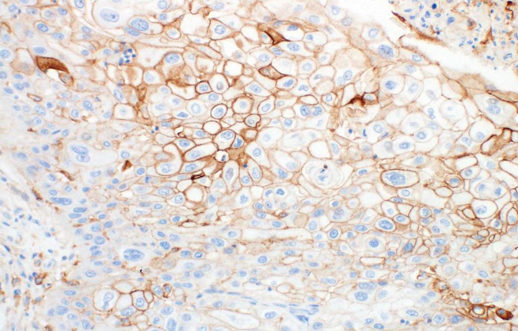 Reporting Results Note: PD-L1 IHC 28-8 pharmdx was validated for invasive UC tissue samples and not for lesions with foci of dysplasia or carcinoma in situ.