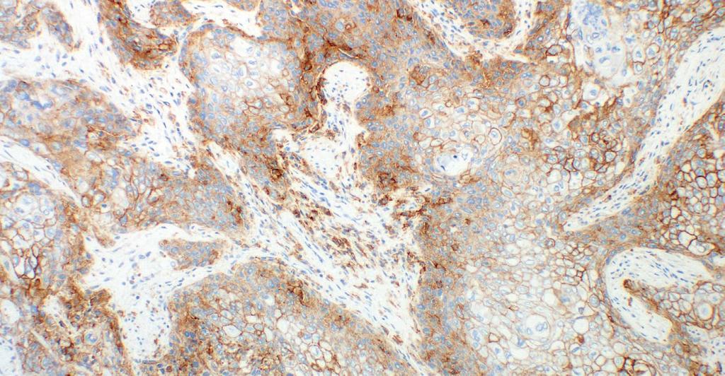 Figure 11: Urothelial carcinoma of the bladder demonstrating