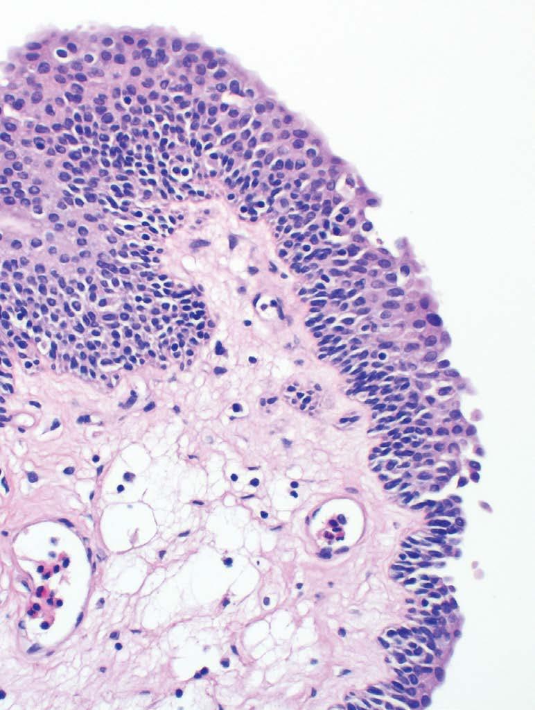 Figure 12: Urothelial carcinoma of the bladder showing strong staining of intra-tumoral associated immune cells (red arrows), while the
