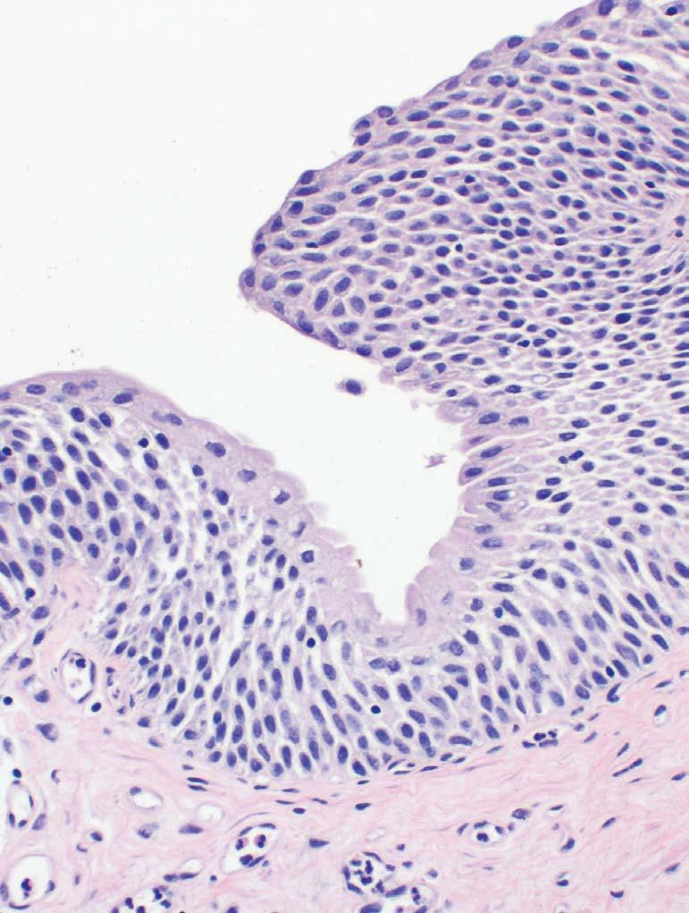 tumor cells (black arrows).