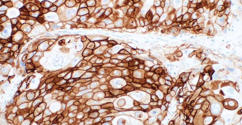 Challenging Cases for UC PD-L1 IHC 28-8 pharmdx Non-Specific Background Staining Background staining is defined as diffuse, non-specific staining of a specimen. It is caused by several factors.