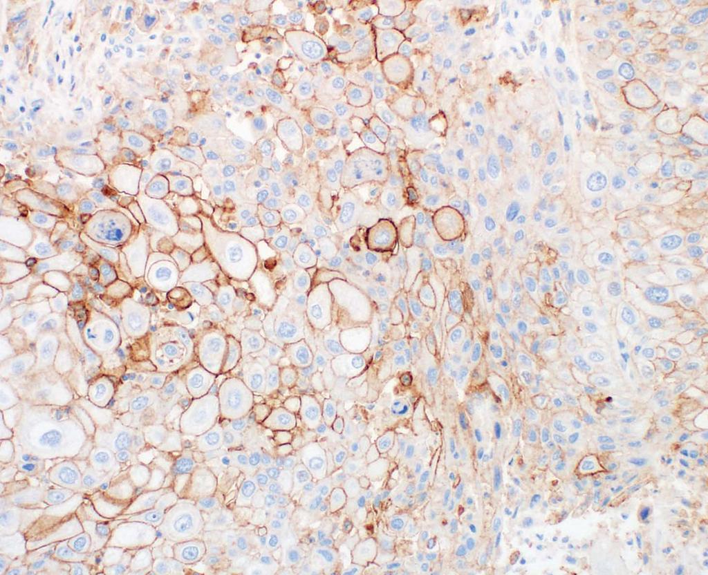 paraffin-embedded (FFPE) non-squamous non-small cell lung cancer (NSCLC), squamous cell carcinoma of the head and neck (SCCHN), urothelial carcinoma (UC), and melanoma tissues using EnVision FLEX