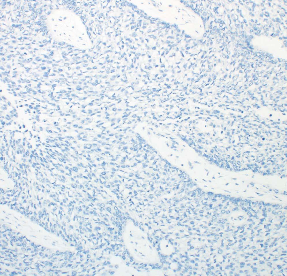 PD-L1 IHC 28-8 pharmdx Technical Checklist Guidelines for Scoring PD-L1 IHC 28-8 pharmdx Customer Name / Institution: Name and Title: Autostainer Link 48 Serial Number: Software Version: Regular