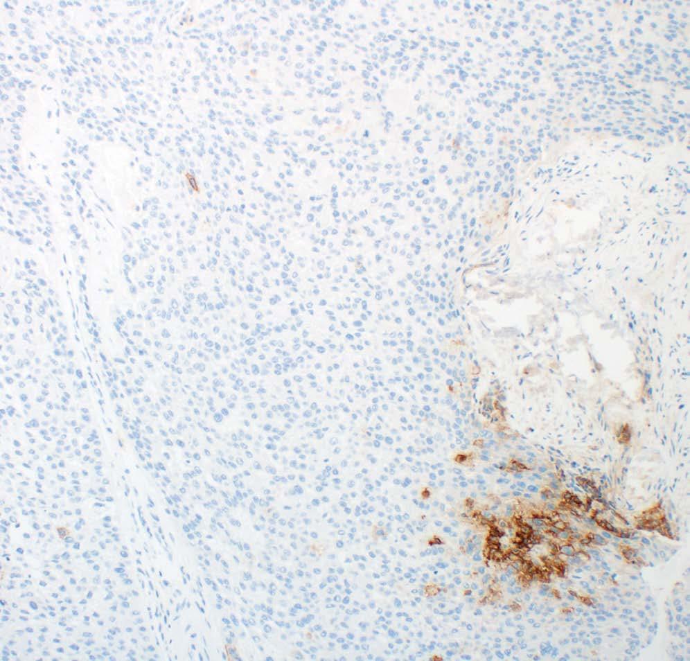Yes No PD-L1 IHC 28-8 pharmdx is used before the expiration date printed on the outside of the box?