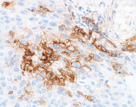 H&E stained slides should accompany each PD-L1 stained sample to allow proper assessment of invasive carcinoma, carcinoma in situ, and adjacent normal epithelium.