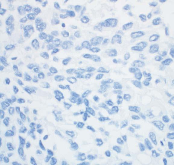 Control Tissue Stained with PD-L1 Primary Antibody Patient Specimen Stained