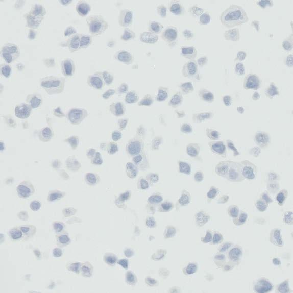 Exclude from scoring: Cytoplasmic staining Immune cells Normal cells Necrotic