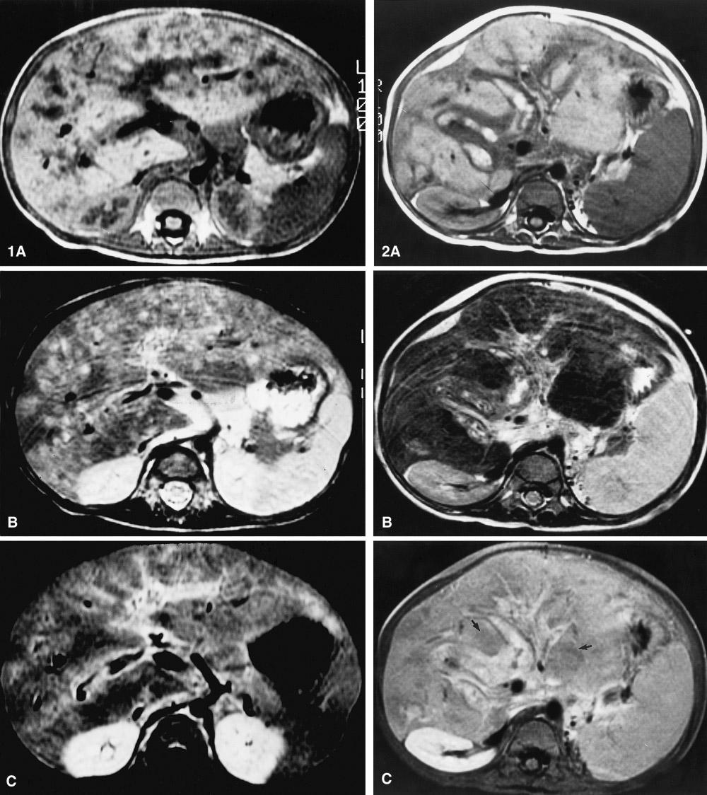 M. Kim et al.: MRI of hepatic Langerhans cell histiocytosis 375 Fig. 1. Case 1.