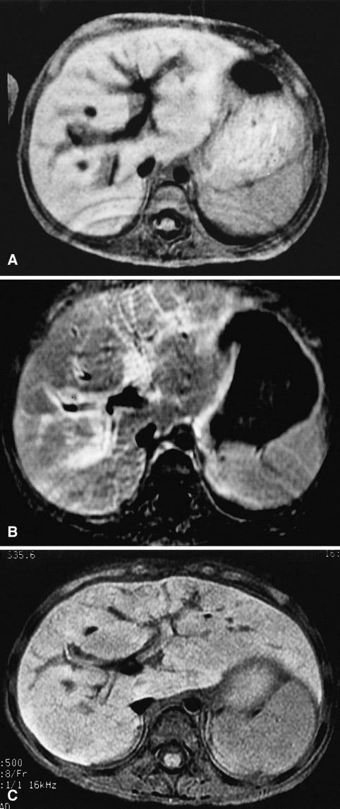376 M. Kim et al.: MRI of hepatic Langerhans cell histiocytosis or nodular. Some hypoechoic nodules looked like targets.