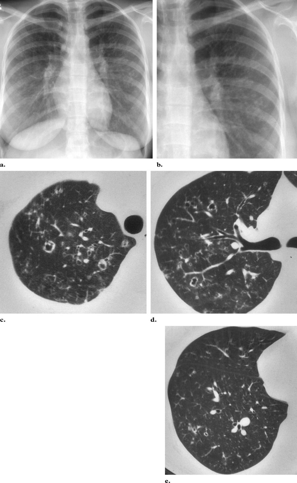 830 May-June 2004 RG f Volume 24 Number 3 Figure 8. PLCH in an 18-year-old woman with chronic cough and no known history of cigarette smoking.