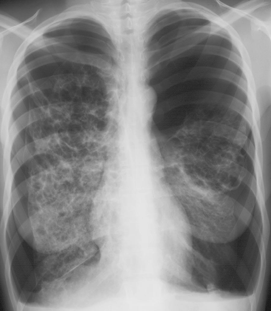 Posteroanterior (a) and posteroanterior collimated (b) radiographs show bilateral coarse reticular areas of opacity and cystic changes that predominantly involve the upper and middle lung zones and