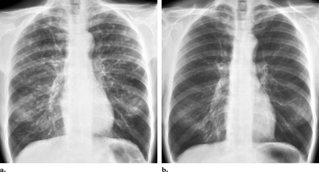 832 May-June 2004 RG f Volume 24 Number 3 Figure 11. PLCH in a 54-year-old woman with pleuritic chest pain.