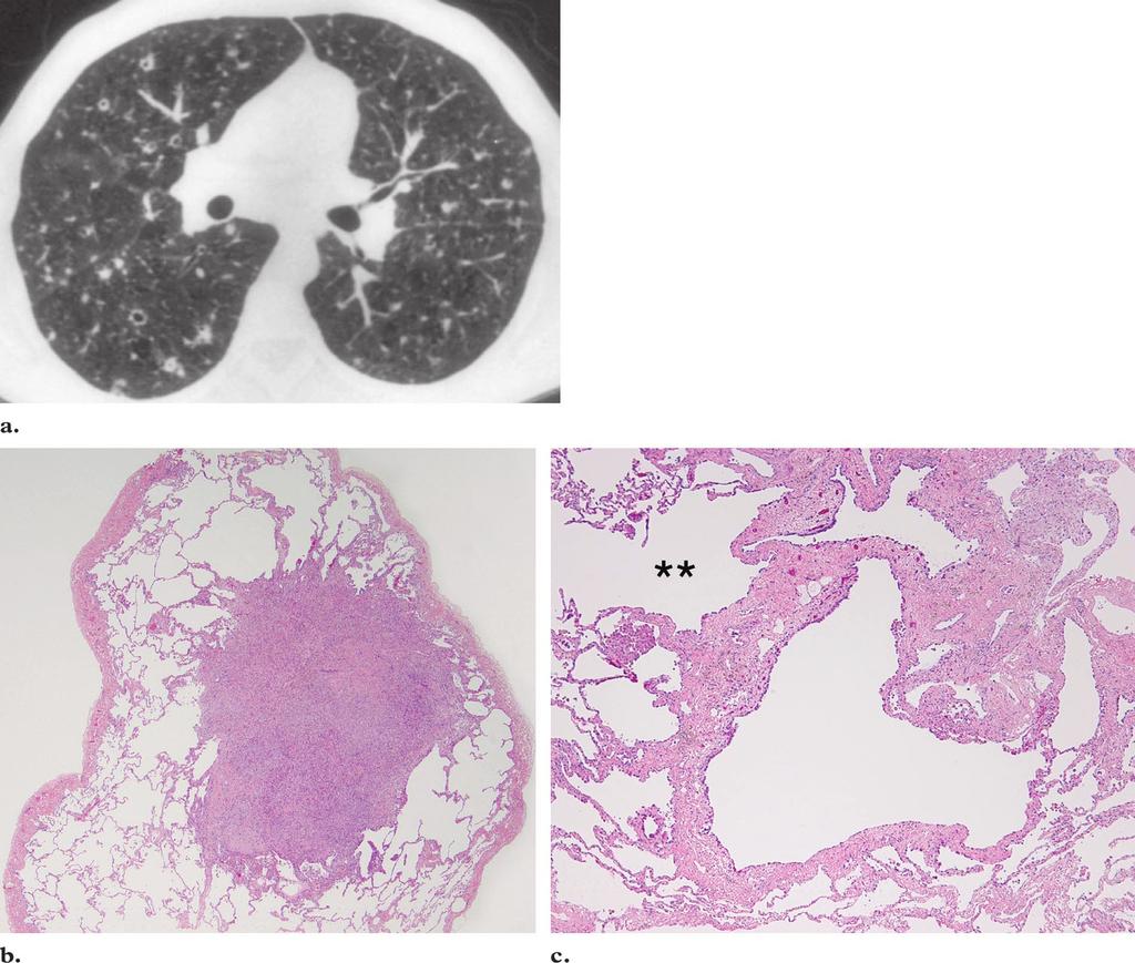 RG f Volume 24 Number 3 Abbott et al 833 Figure 12. PLCH in a 31-year-old man with cough, anorexia, weight loss, and a 15 pack-year history of cigarette smoking.