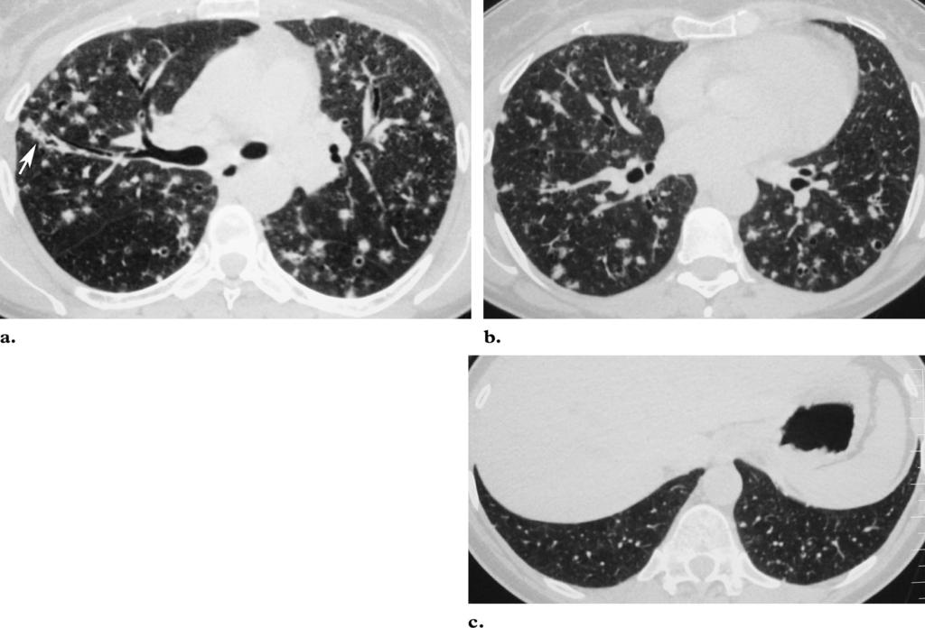 PLCH in a 49-year-old woman with a history of cigarette smoking, increasing cough, and new onset of dyspnea.